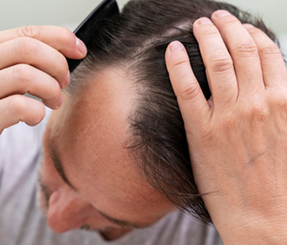 Hair Loss